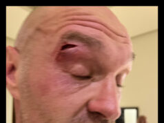 Tyson Fury Gets Cut; Usyk Fight Postponed–Statement