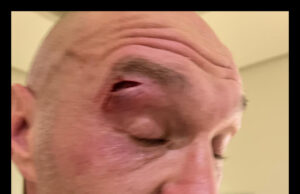 Tyson Fury Gets Cut; Usyk Fight Postponed–Statement
